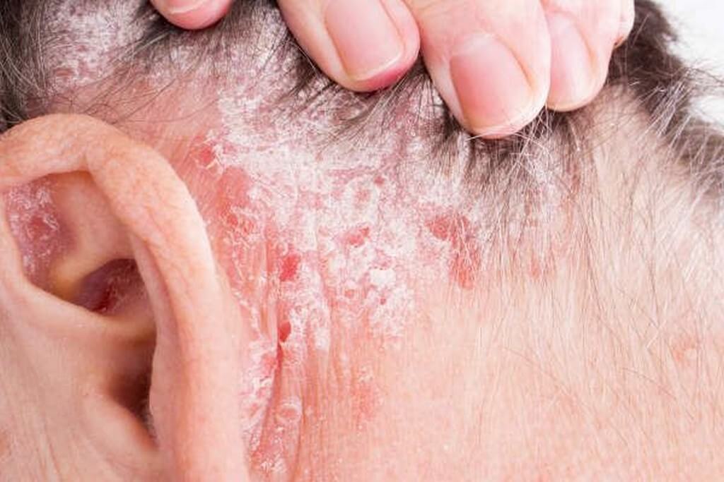 Types of psoriasis: Chronic skin condition types of psoriasis - Types of psoriasis Chronic skin condition 4 - Types of psoriasis: Chronic skin condition 
