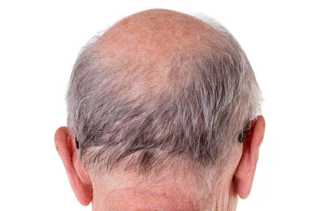 Hair loss: Causes of hair fall in men  hair loss - Hair loss Causes of hair fall in men 1 - Hair loss: Causes of hair fall in men 