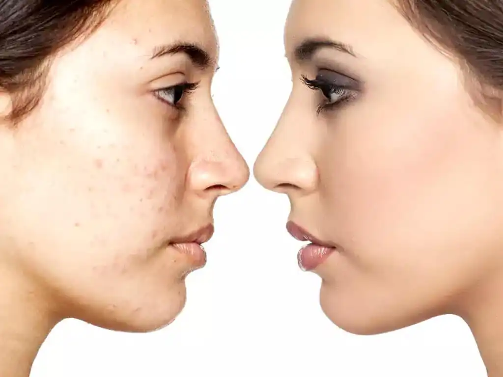 BLEMISHES: HOW TO COVER THEM USING MAKEUP?