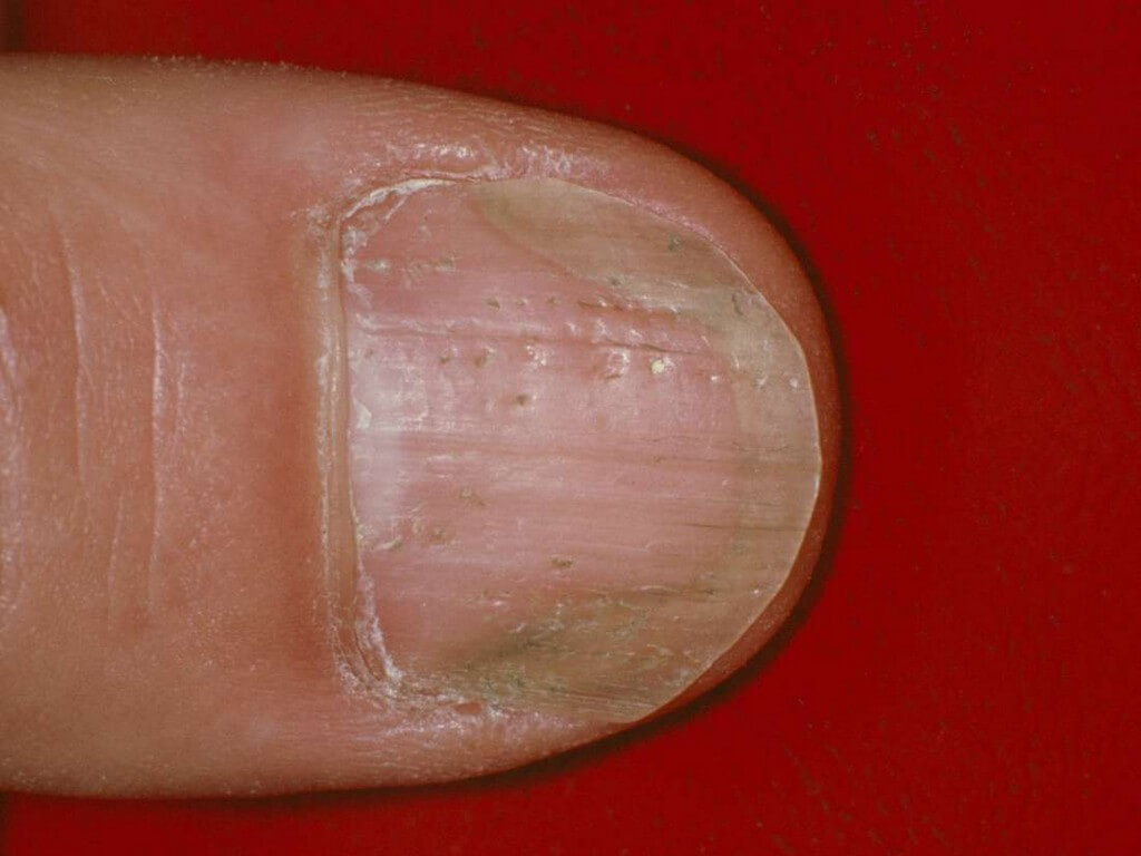 Types of psoriasis: Chronic skin condition
