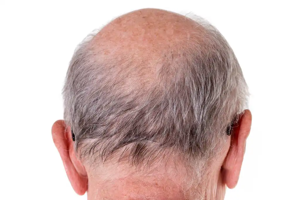 Hair loss: Causes of hair fall in men